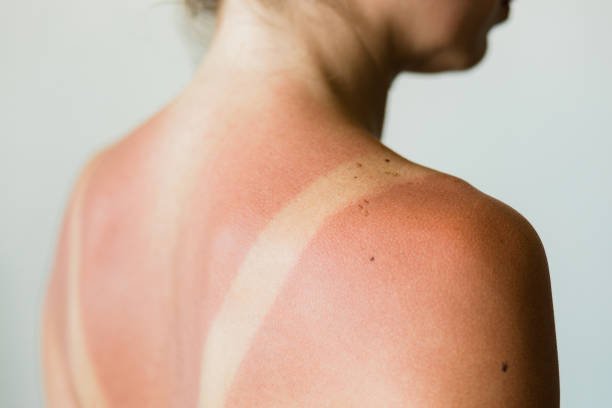 A woman with a sunburned skin