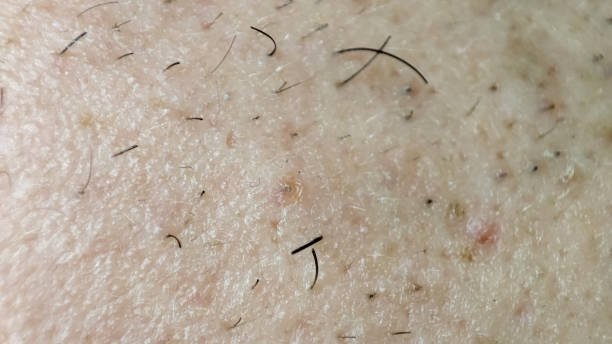 A picture of someon with ingrown hairs