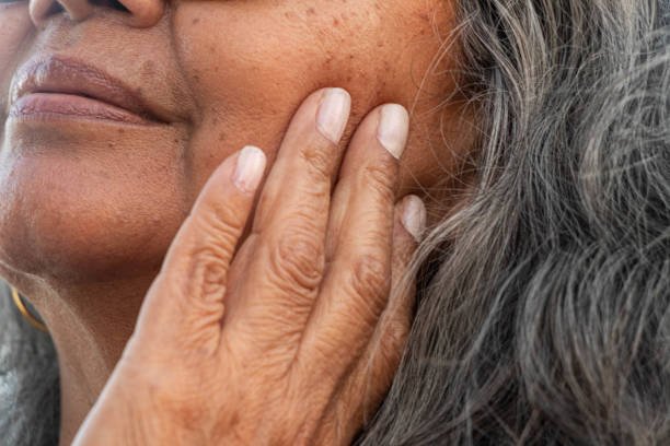 A woman with sunspots and age spots on her face