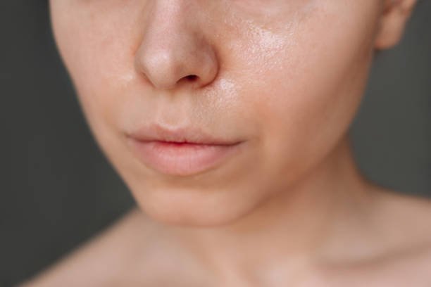 A woman with oily skin during summer