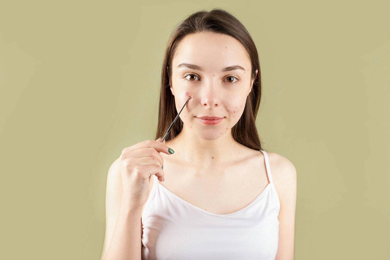 A woman with acne on her face